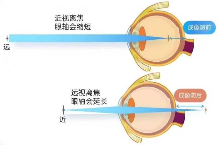 1753423322107936.png 控制近視增長的方法