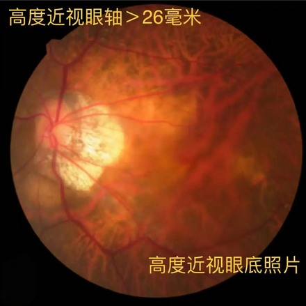 高度近視眼底照片