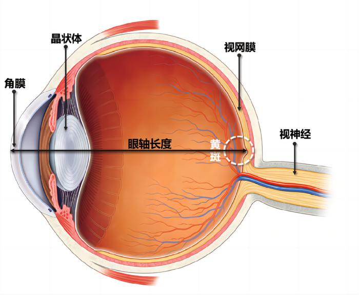 軸性近視和屈光性近視有什么區(qū)別？