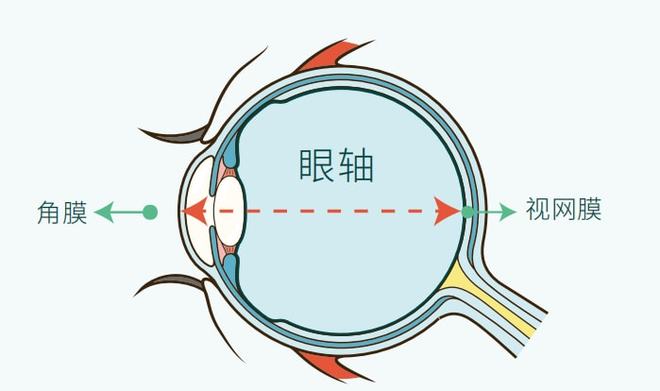 孩子眼軸長但近視度數低，需要擔心嗎？